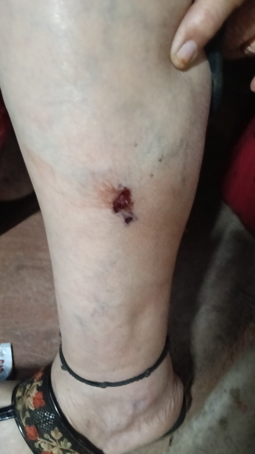 कुत्र्याच्या चाव्याने वृद्ध महिला जखमी; उपनगरीय भागातील भटक्या कुत्र्यांचा प्रश्न पुन्हा ऐरणीवर